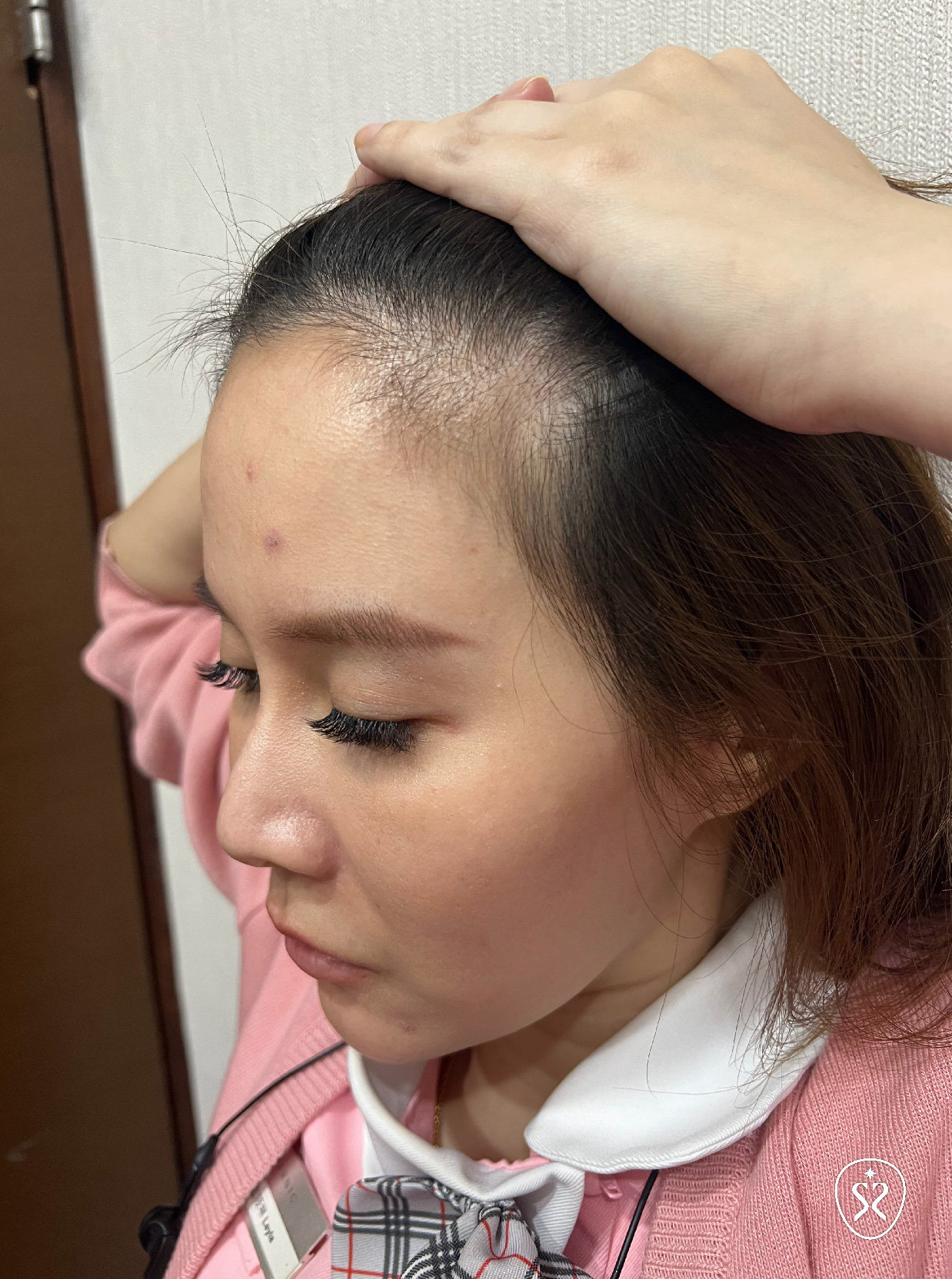 生髮治療需要越早開始成功率越高